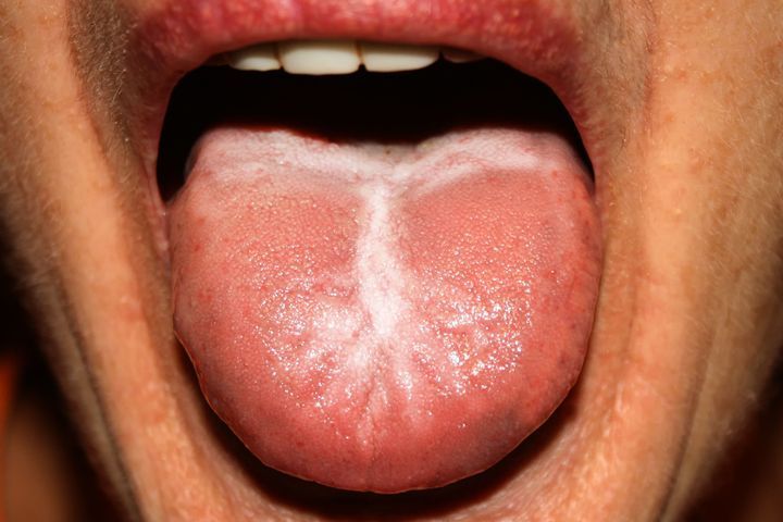 langue blanche causée par la candidose chronique