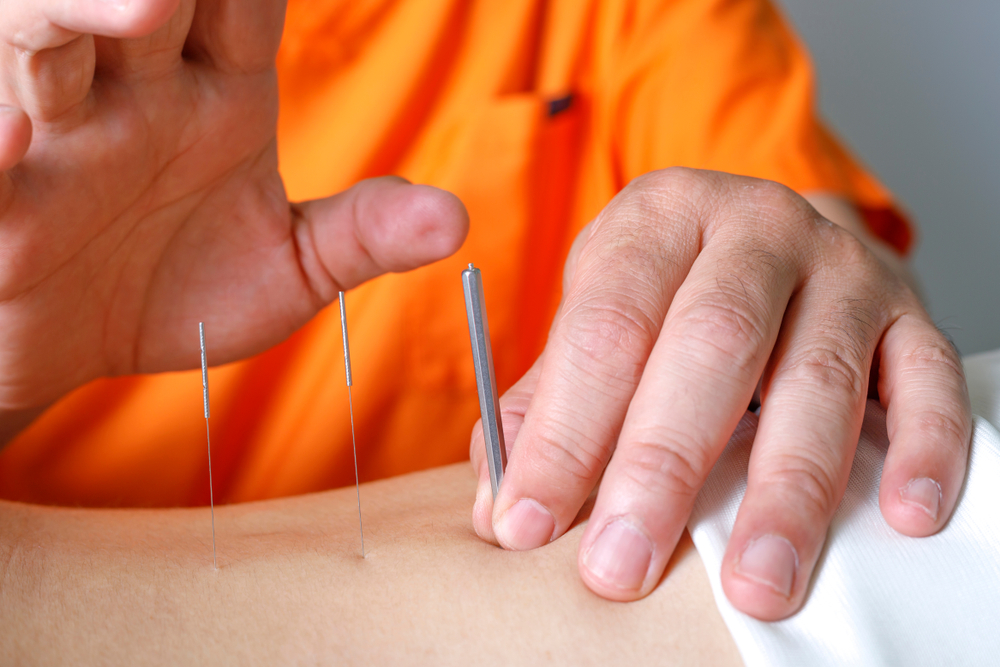 acupuncture dans la médecine traditionnelle chinoise